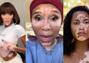 Meet the top female celebrities who have vitiligo on their face