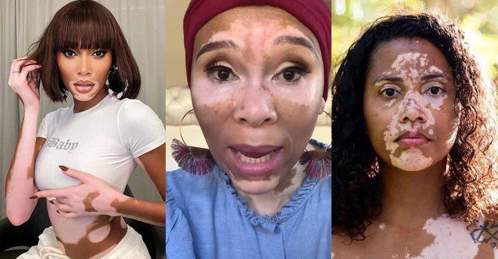 Meet the top female celebrities who have vitiligo on their face